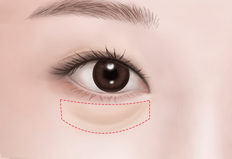 结膜切开及脂肪整理