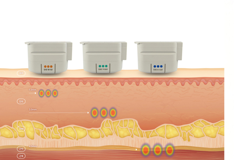匹配皮肤层次的治疗